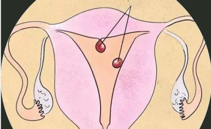 女性内分泌失调不只是会长痘痘,还会导致子宫内膜癌卵巢癌